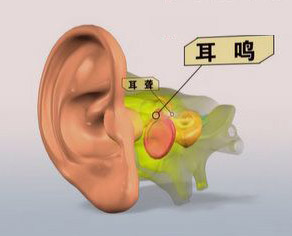 西安京华耳病专家介绍五大策略预防耳鸣